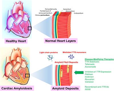 A review of recent clinical trials to evaluate disease-modifying therapies in the treatment of cardiac amyloidosis